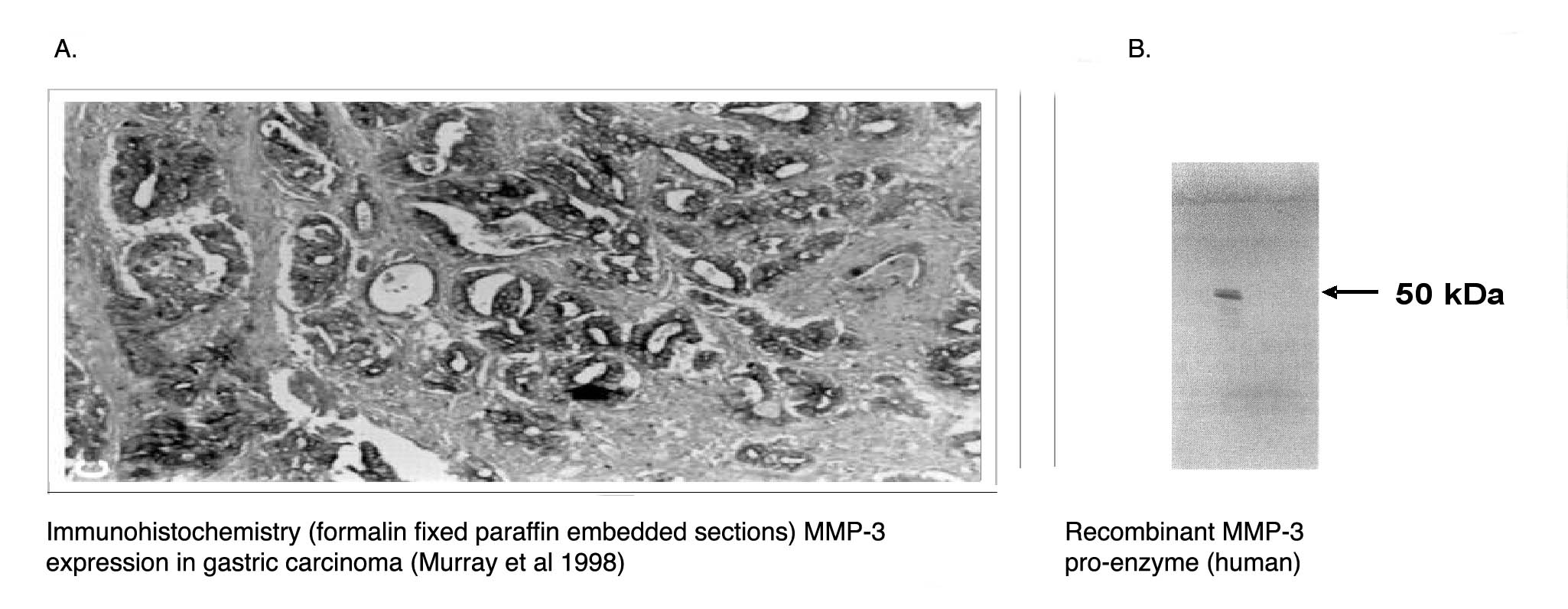 "
Left:  Immunohistochemical staining of human gastric carcinoma tissue using MMP-3 antibody (Cat. No. X2055M).
Right:  Western blot of recombinant human MMP-3 proenzyme using MMP-3 antibody."